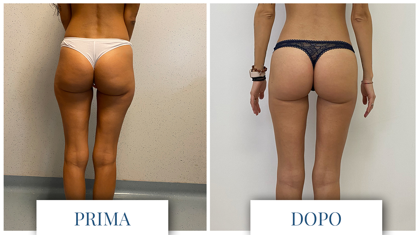 liposuzione prima e dopo donna