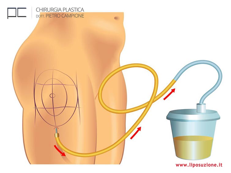 processo liposuzione