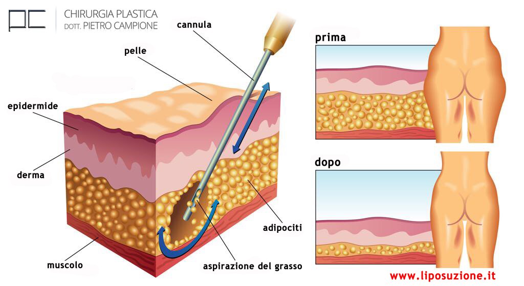 liposuzione risultati